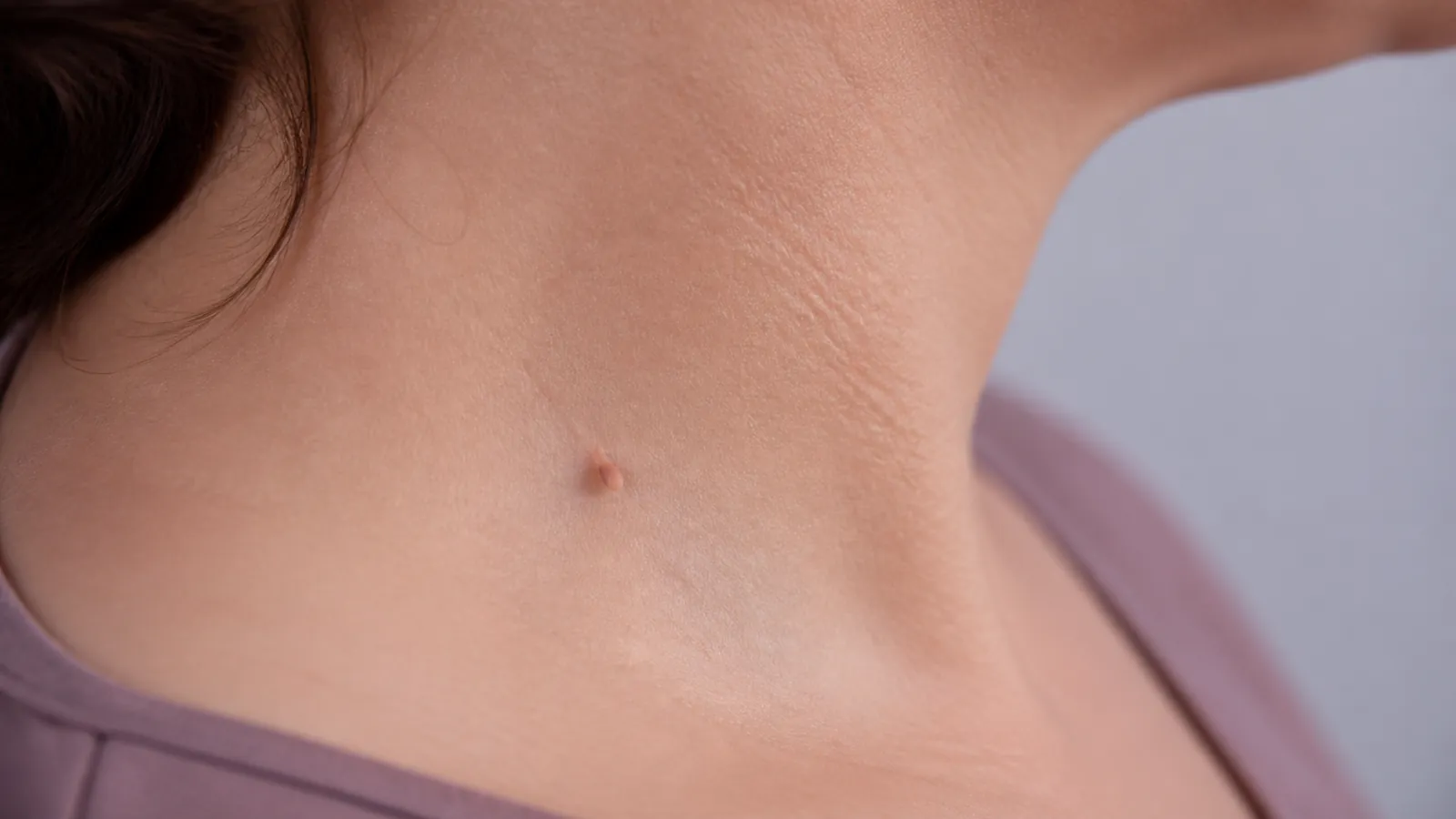 Illustrative close-up of a small flesh-coloured skin tag attached by a narrow stalk on the side of an adult neck