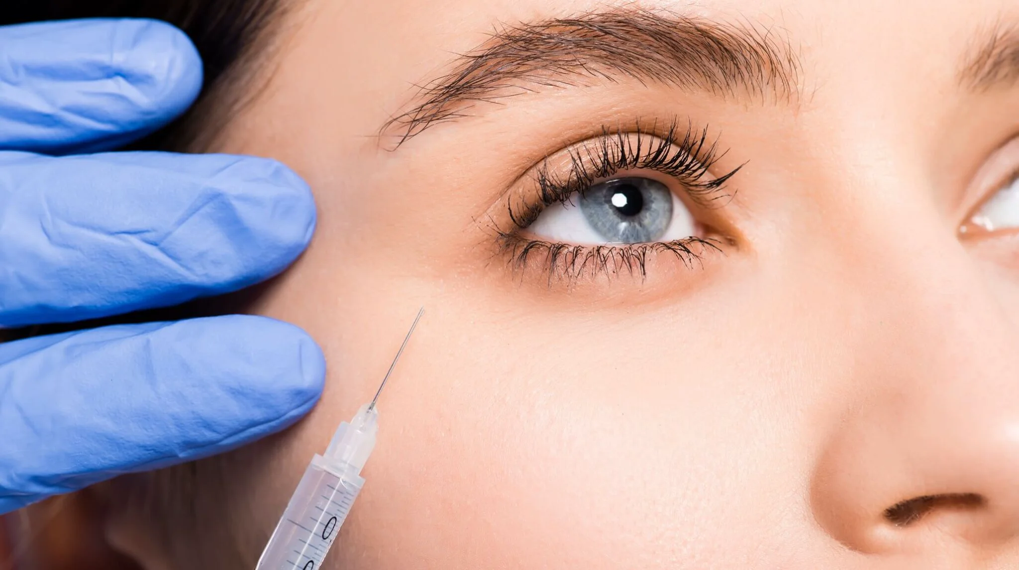 Under-eye filler procedure illustration in a clinical setting