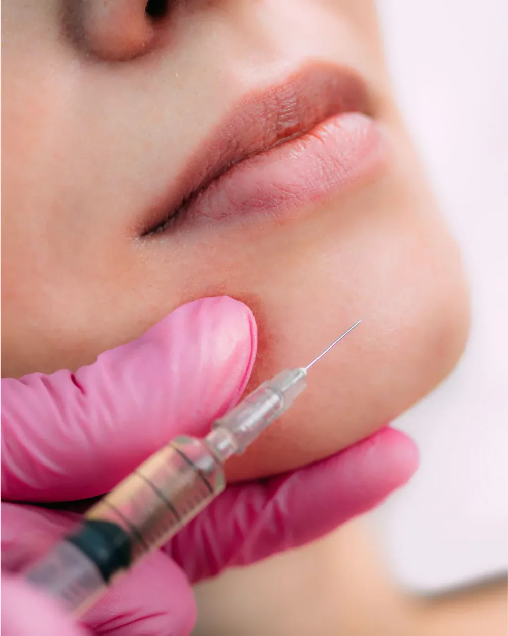 Chin filler injection performed in a clinical setting