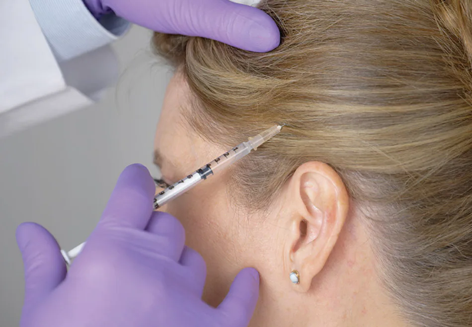 Botulinum-toxin treatment near the temple as part of a migraine protocol