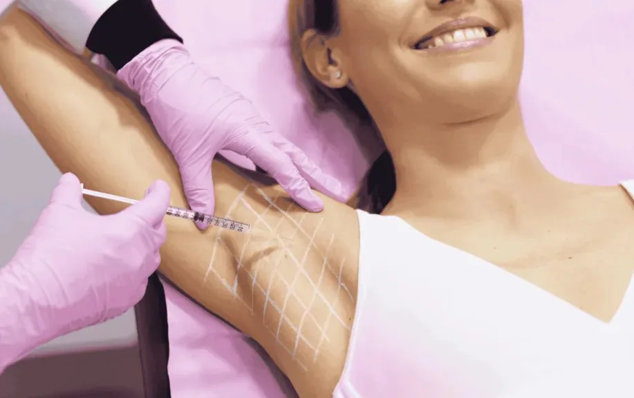 Mapped underarm botulinum-toxin treatment for excessive sweating