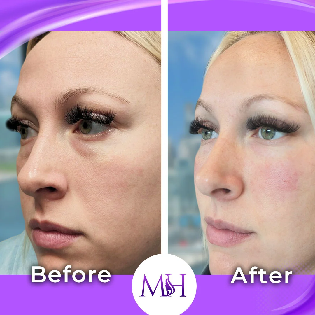 Before and after under-eye treatment result