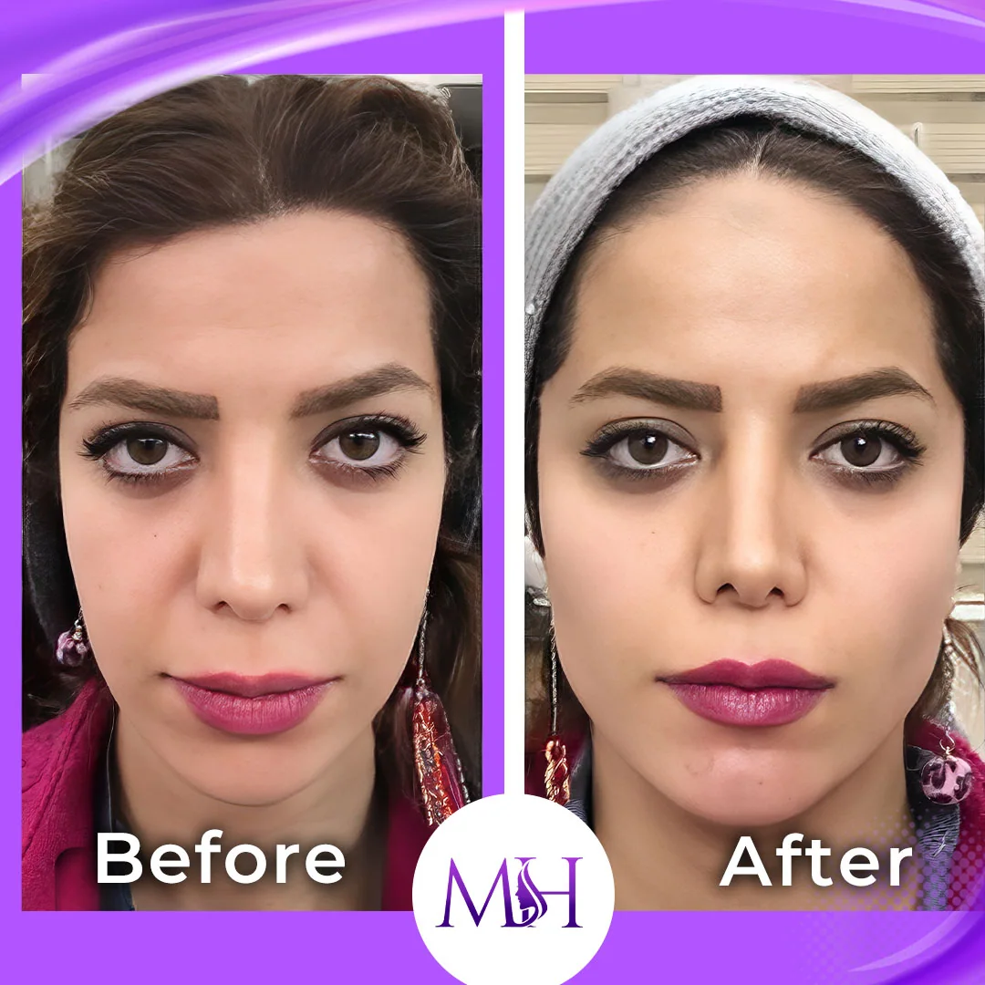 Before and after facial balancing result
