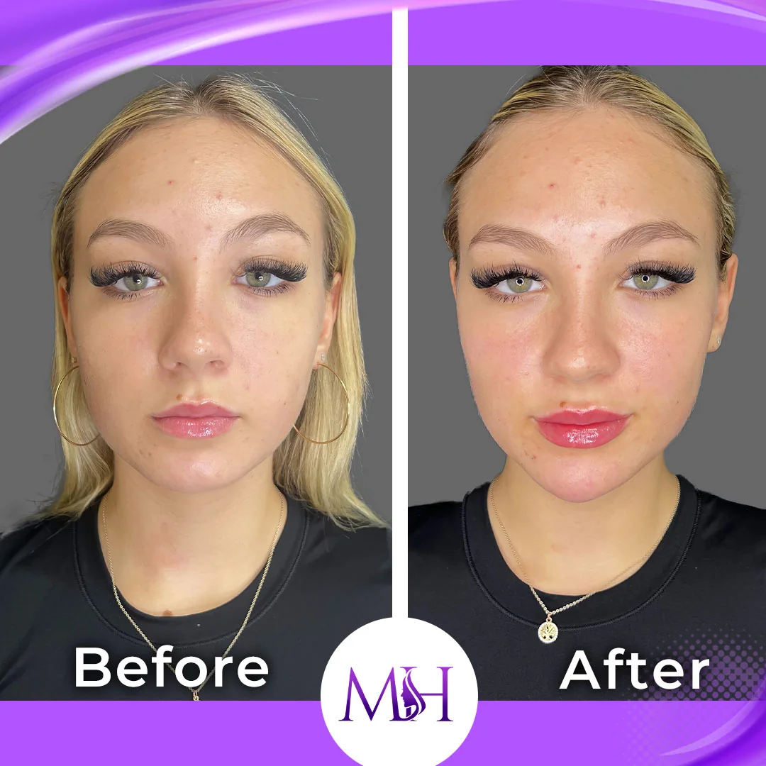 Before and after facial rejuvenation result