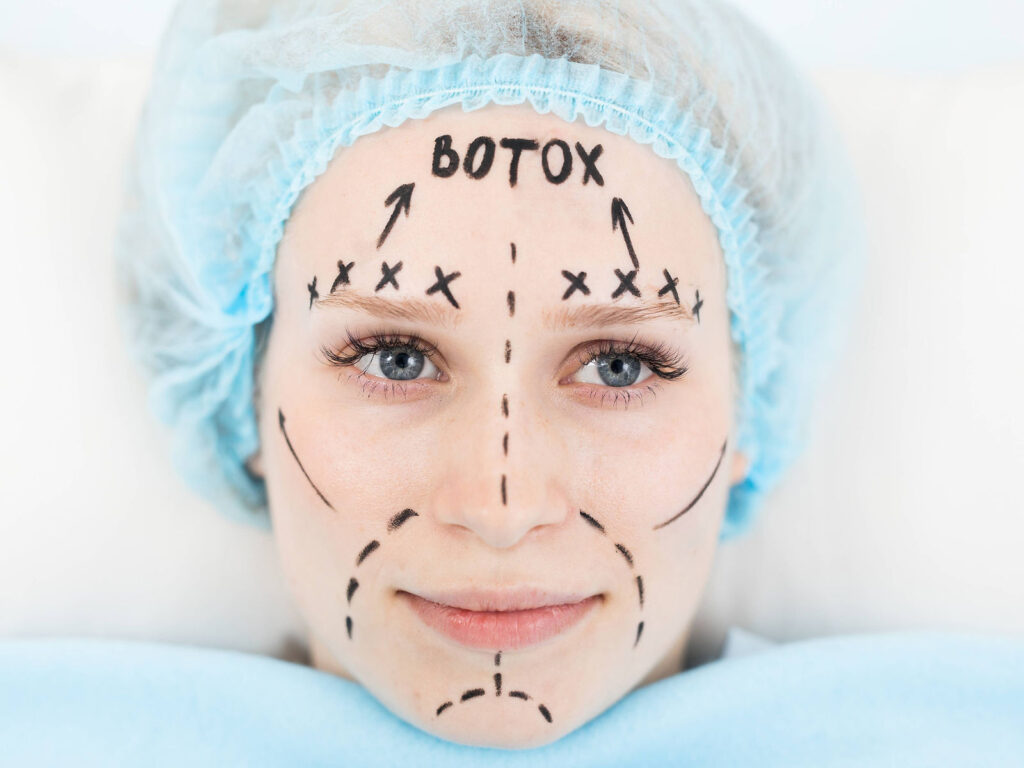 Patient with Botox treatment markings on the forehead and face during pre-injection planning.