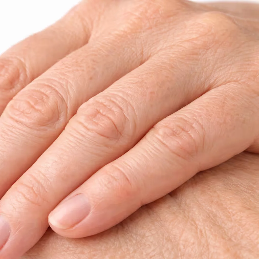 Close-up of hands showing thin skin texture and fine lines associated with aging