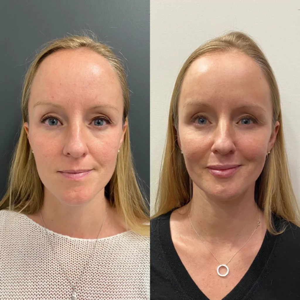 Clinic-supplied before and after cheek fillers case patient result