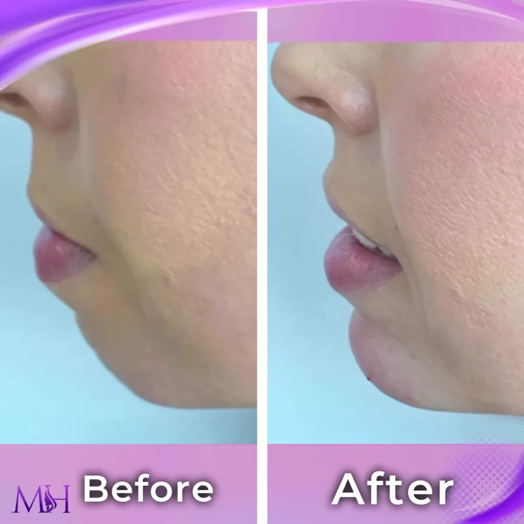 Clinic-supplied before and after chin fillers case patient result