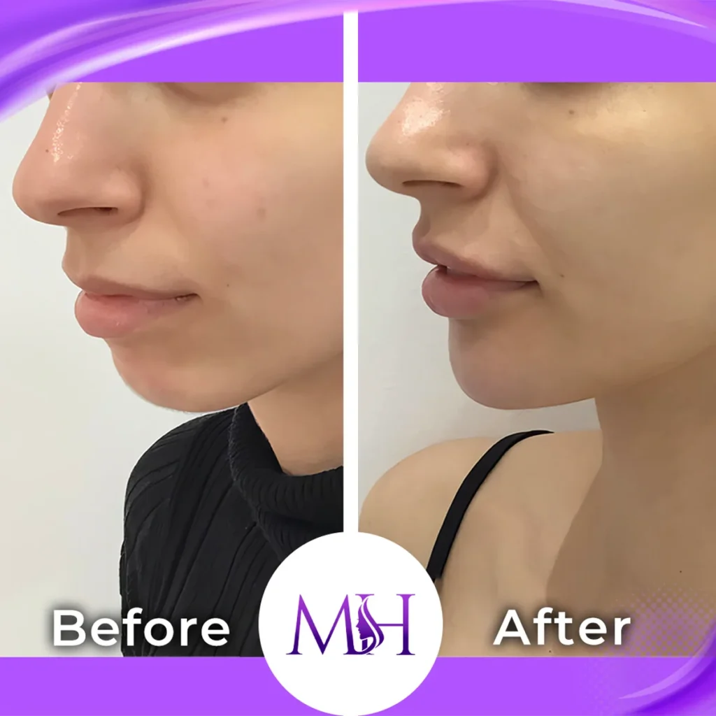 Clinic-supplied before and after chin fillers case patient result