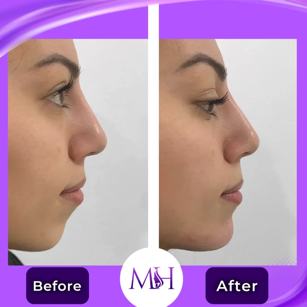Clinic-supplied before and after chin fillers case patient result