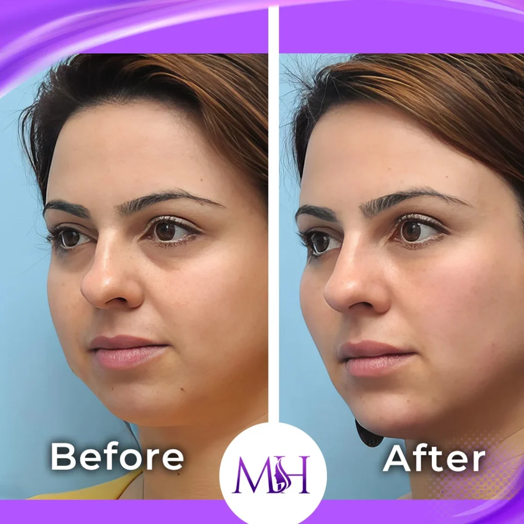 Clinic-supplied before and after dermal fillers case patient result