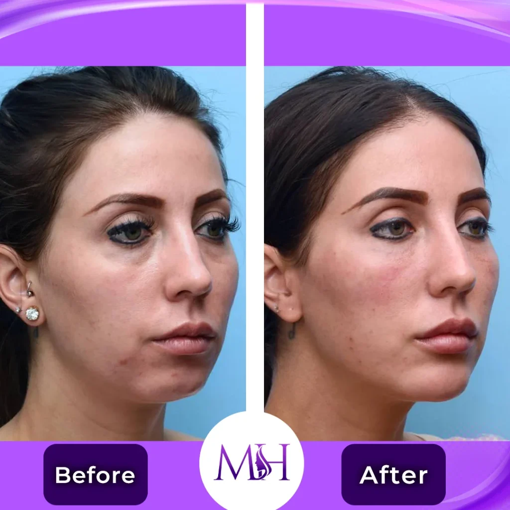 Clinic-supplied before and after dermal fillers case patient result