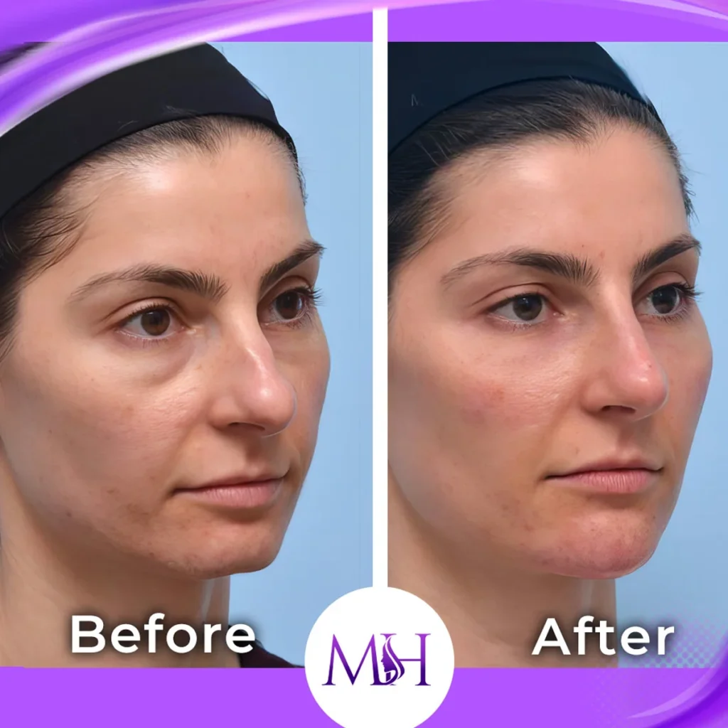 Clinic-supplied before and after full face fillers case patient result