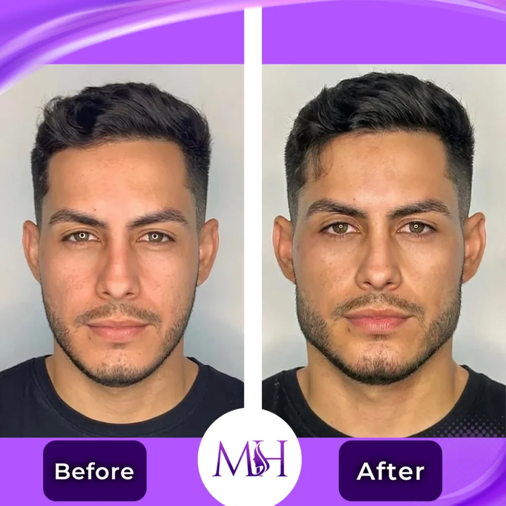 Clinic-supplied before and after full face fillers case patient result