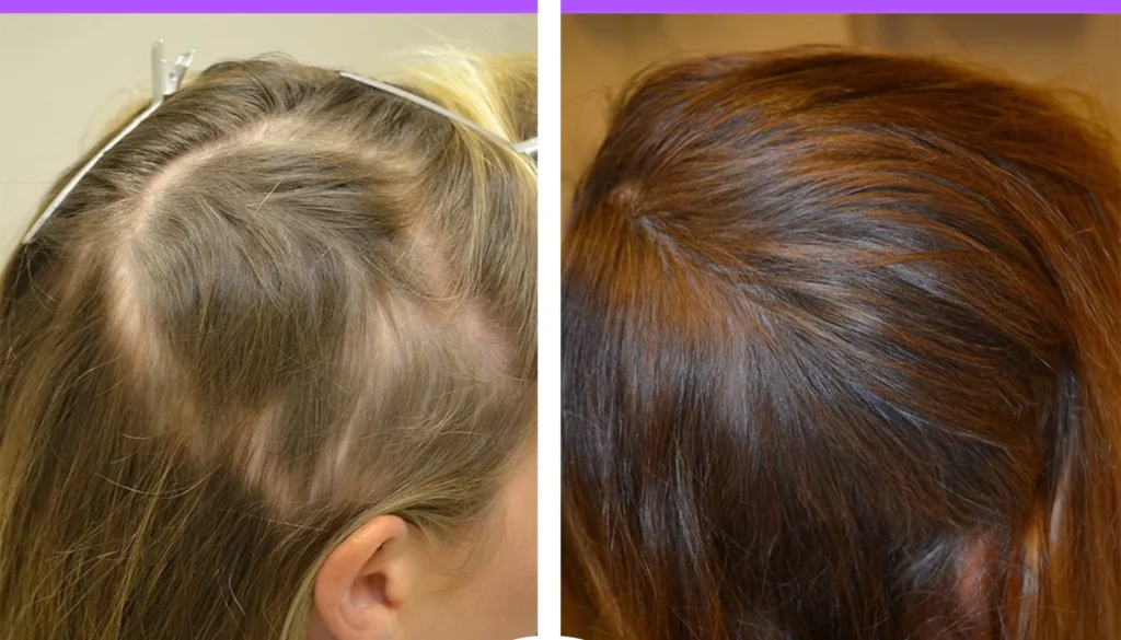Clinic-supplied before and after PRP hair treatment result