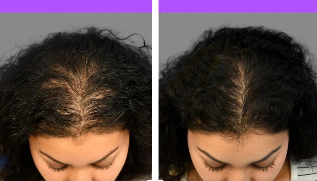 Clinic-supplied before and after PRP hair treatment result