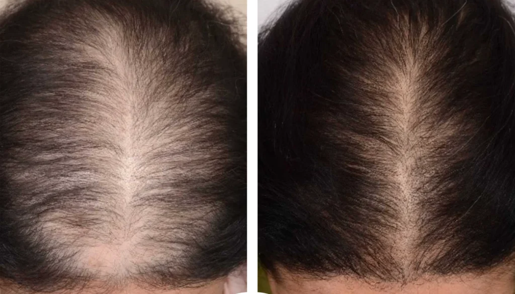 Clinic-supplied before and after PRP hair treatment result