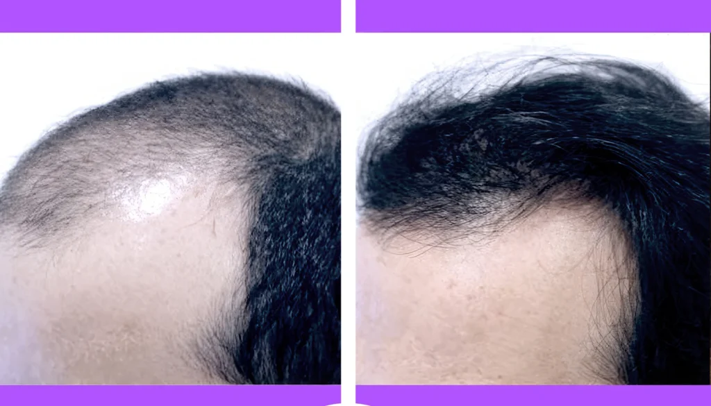 Clinic-supplied before and after PRP hair treatment result