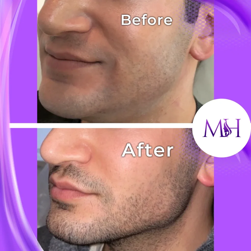 Clinic-supplied before and after jawline fillers case patient result