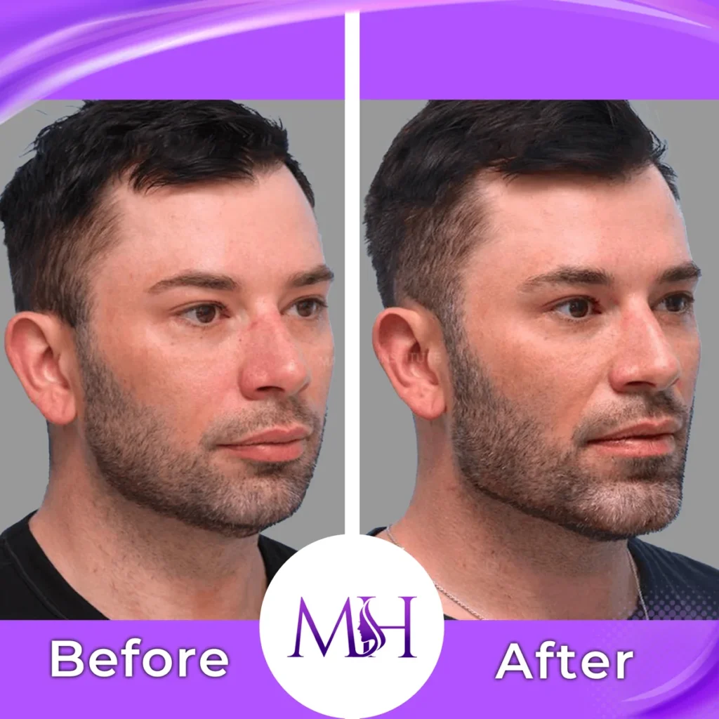 Clinic-supplied before and after jawline fillers case patient result
