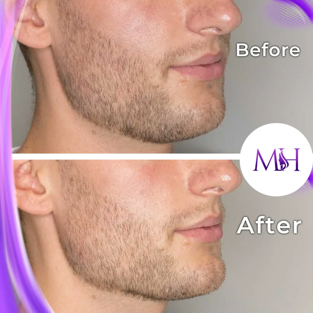 Clinic-supplied before and after jawline fillers case patient result