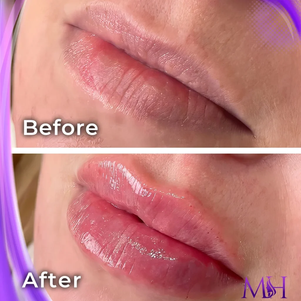 Clinic-supplied before and after lip fillers case patient result