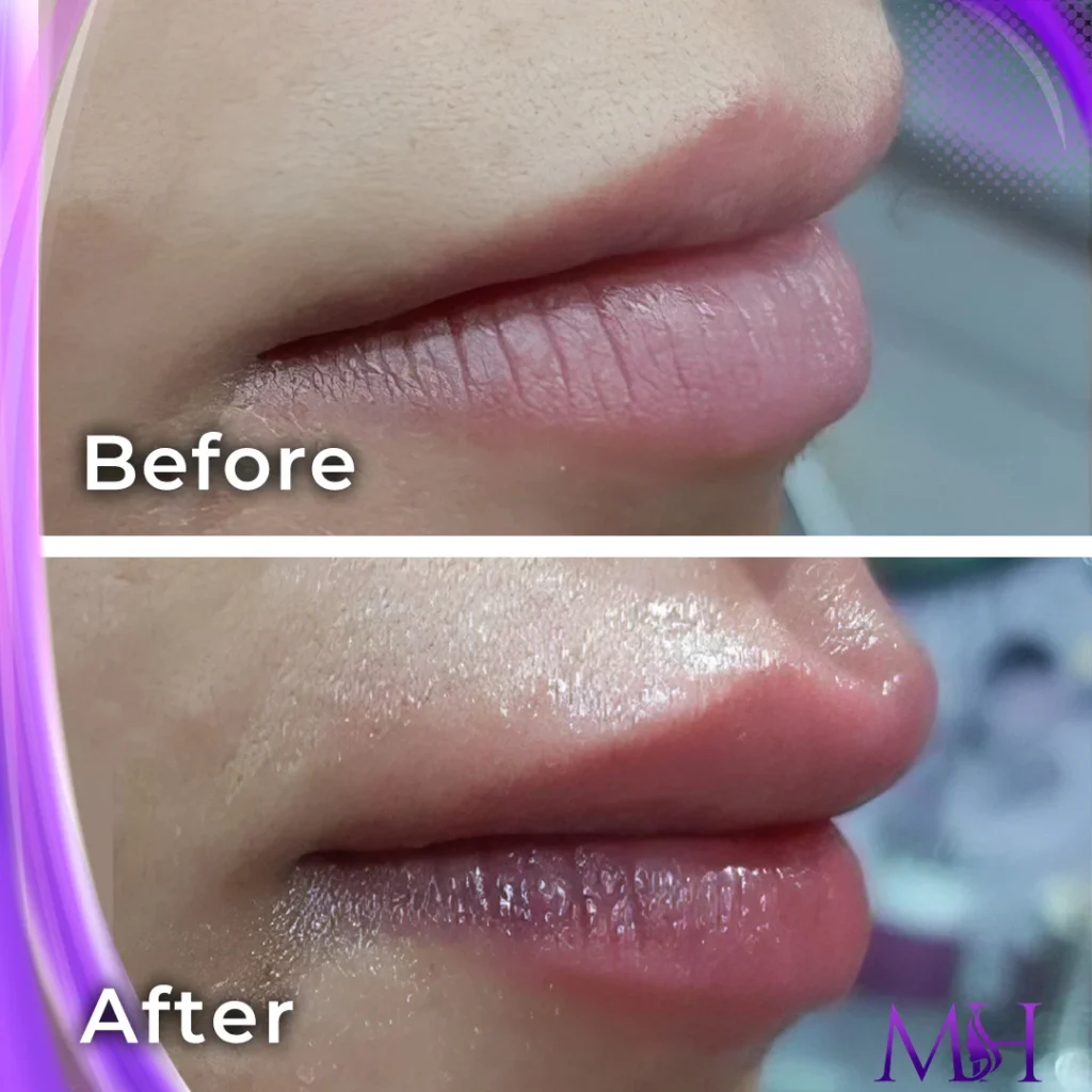 Clinic-supplied before and after lip fillers case patient result