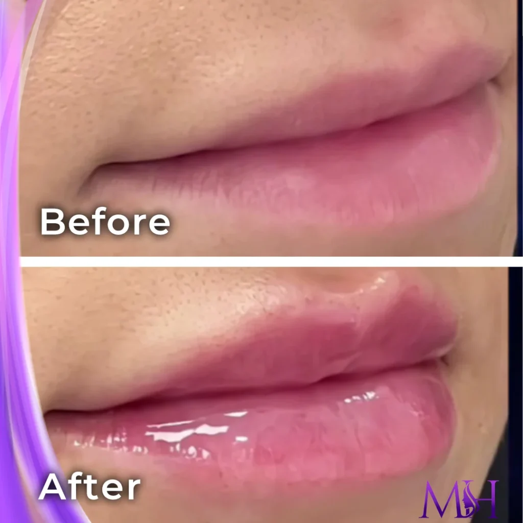 Clinic-supplied before and after lip fillers case patient result