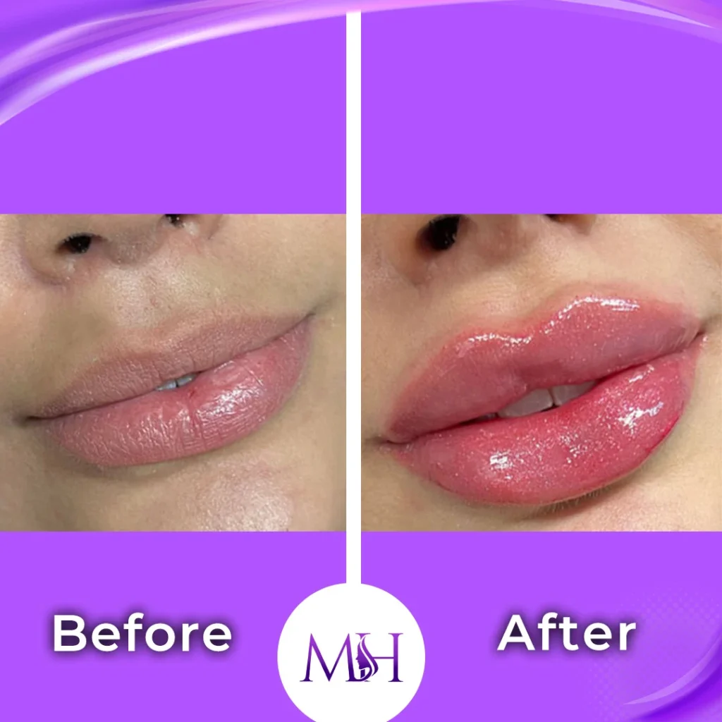 Clinic-supplied before and after lip fillers case patient result