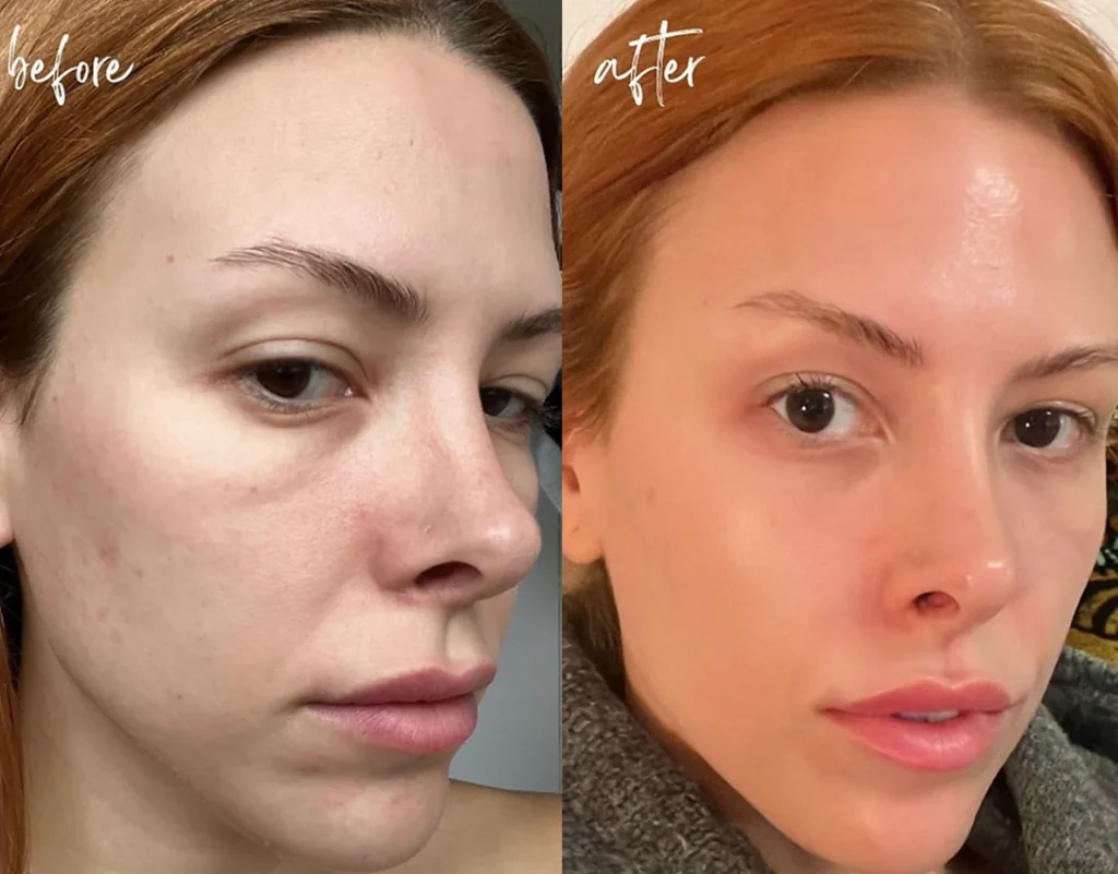 Clinic-supplied before and after profhilo case patient result