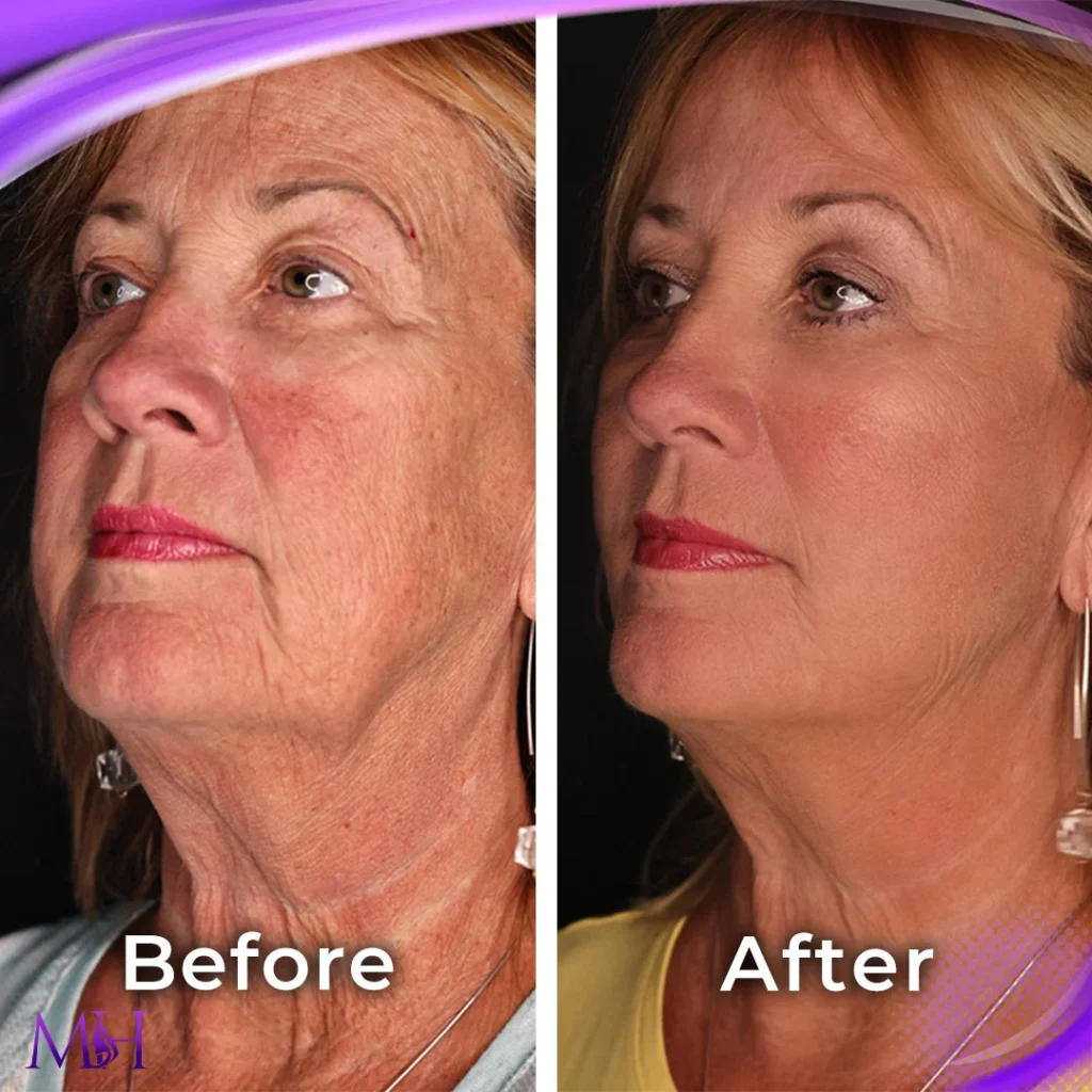 Clinic-supplied before and after skin booster case patient result
