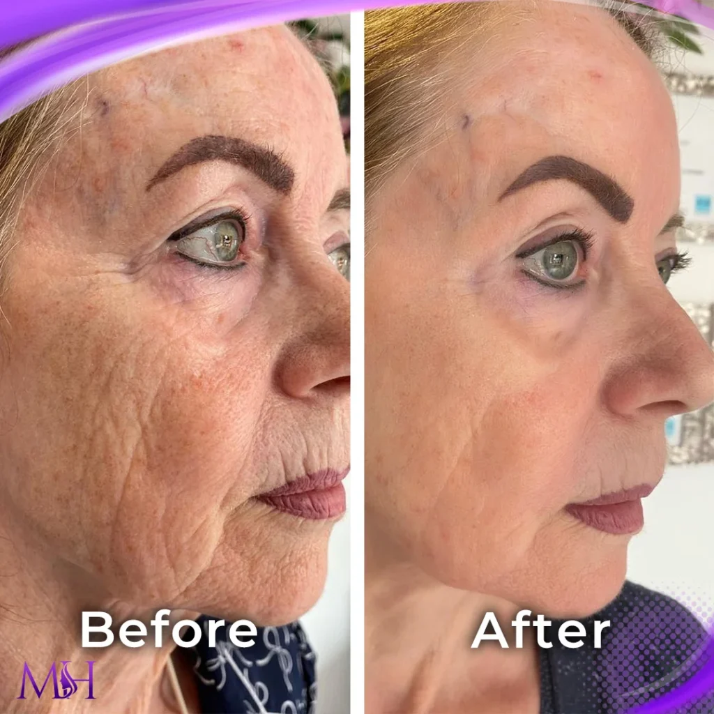 Clinic-supplied before and after skin booster case patient result