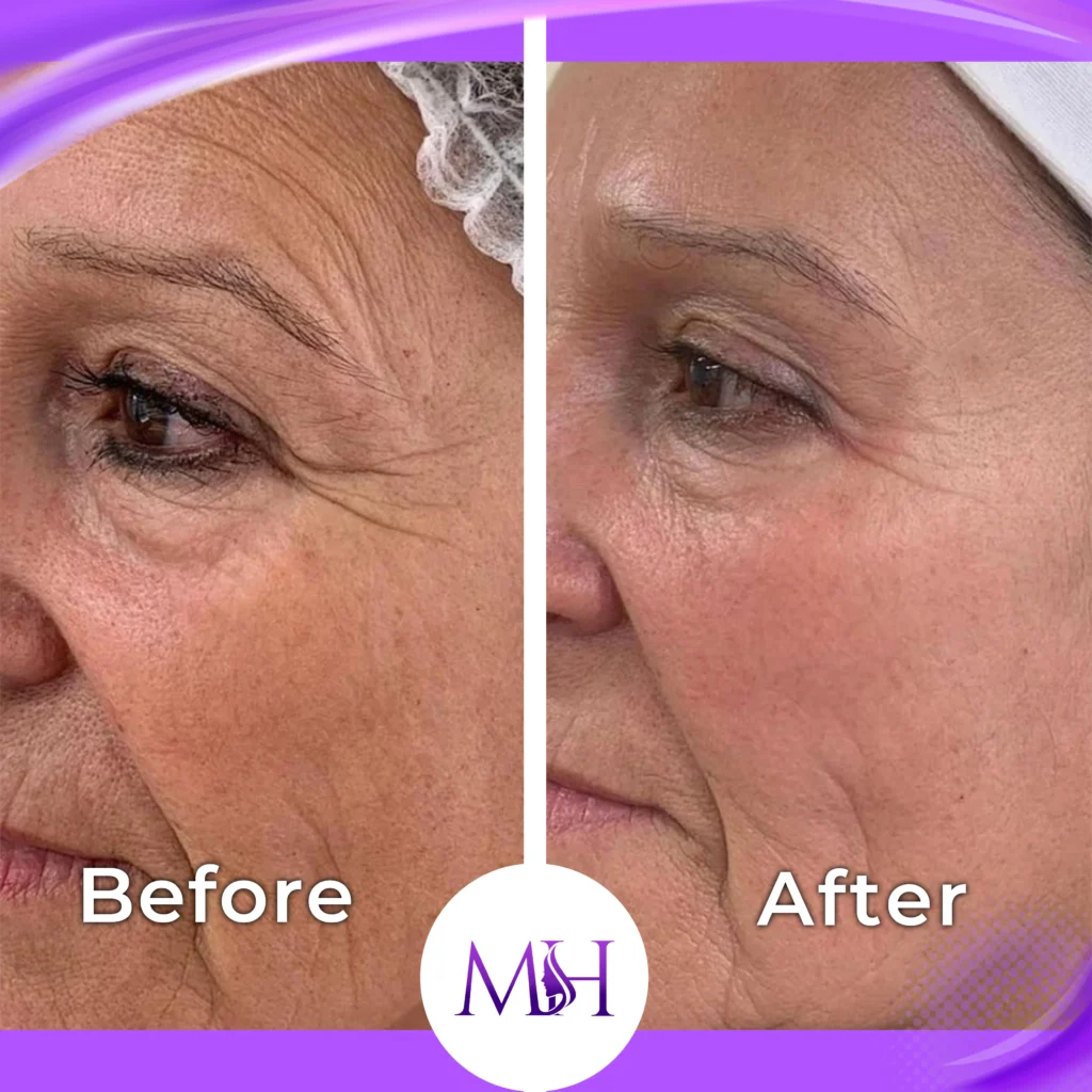 Clinic-supplied before and after skin booster case patient result