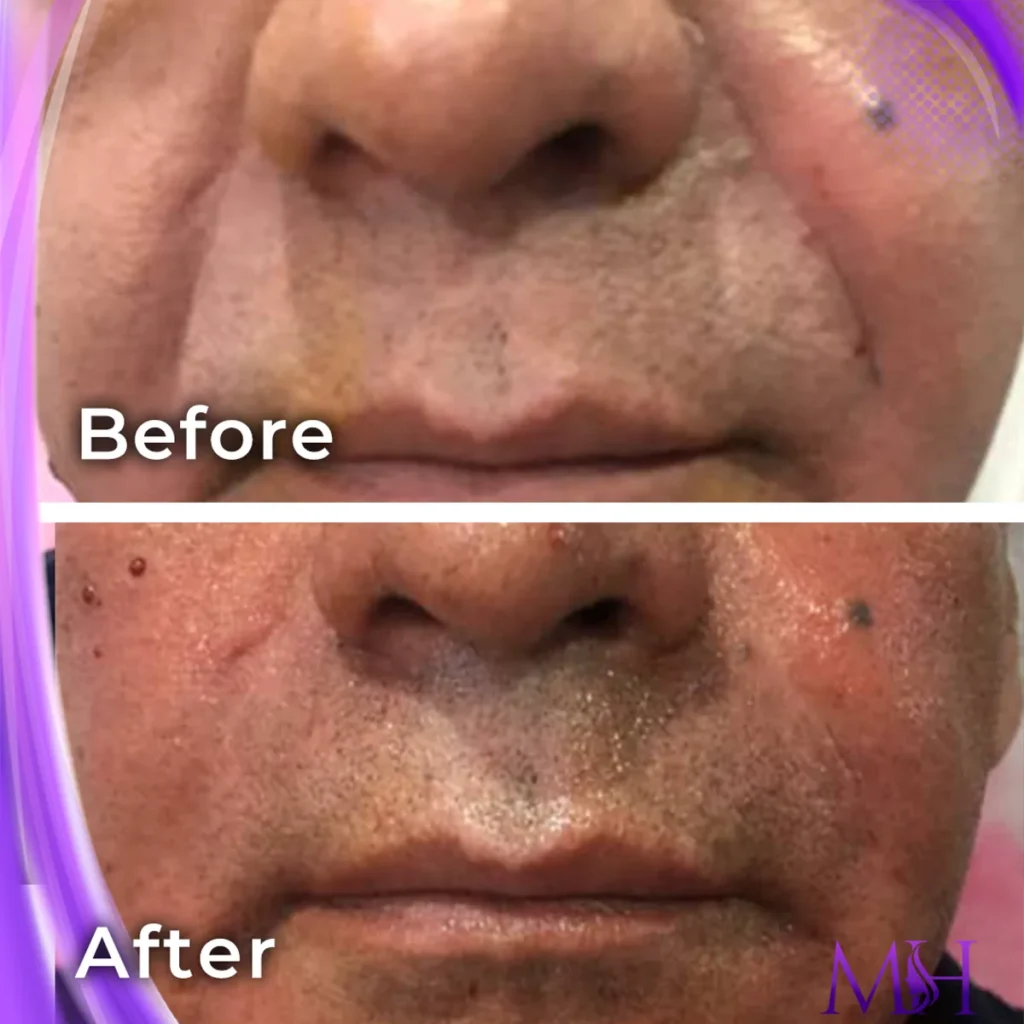 Clinic-supplied before and after smile line fillers case patient result