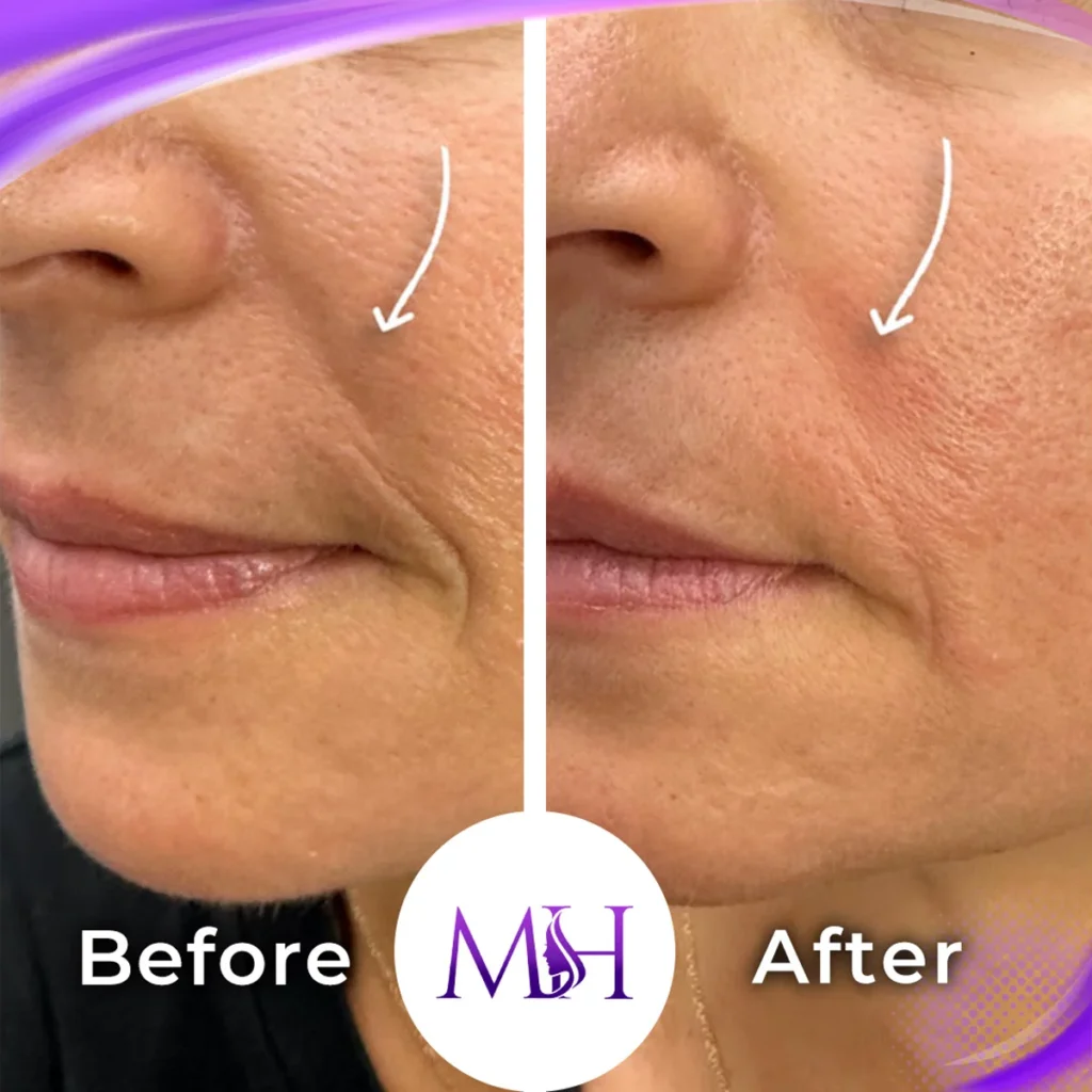 Clinic-supplied before and after smile line fillers case patient result