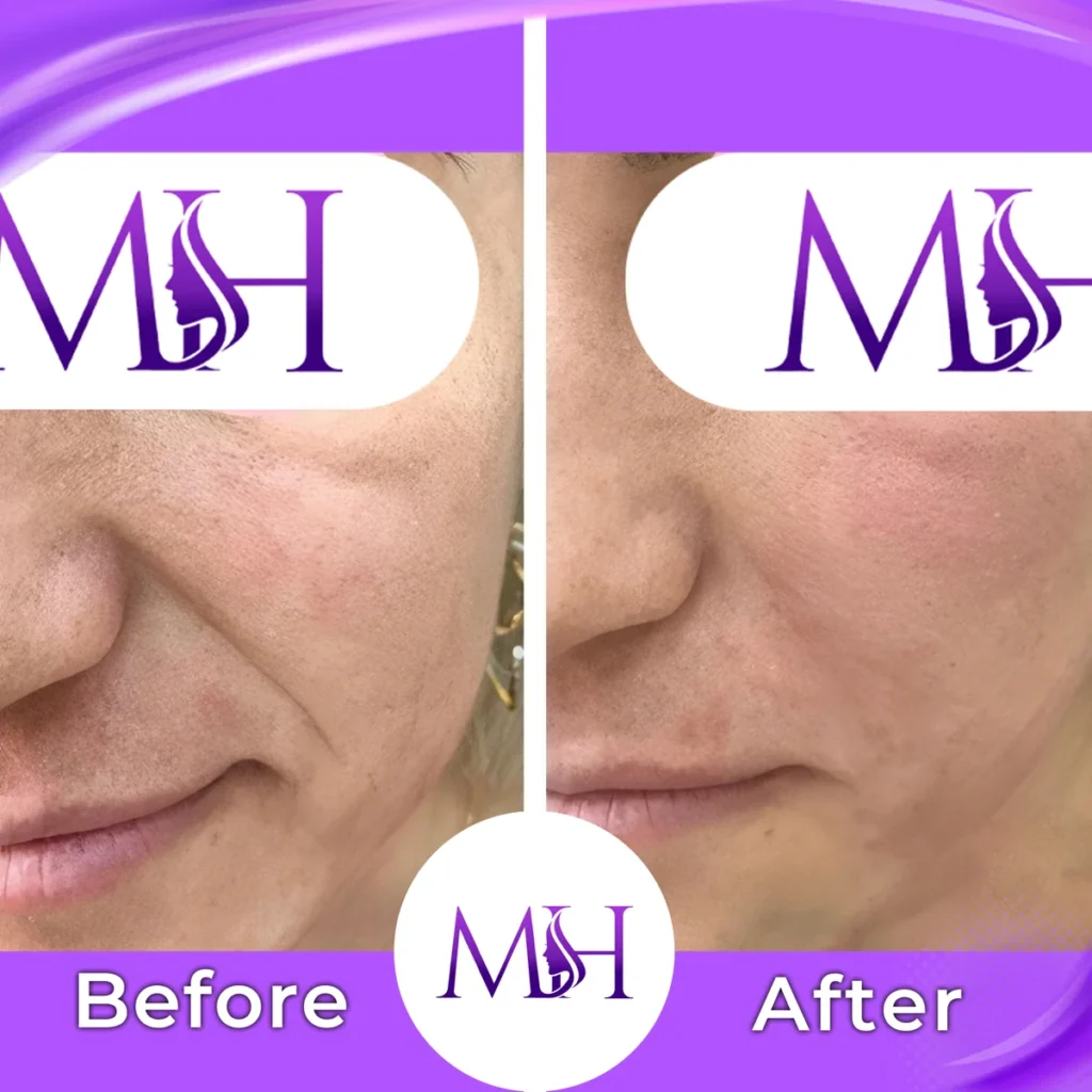Clinic-supplied before and after smile line fillers case patient result