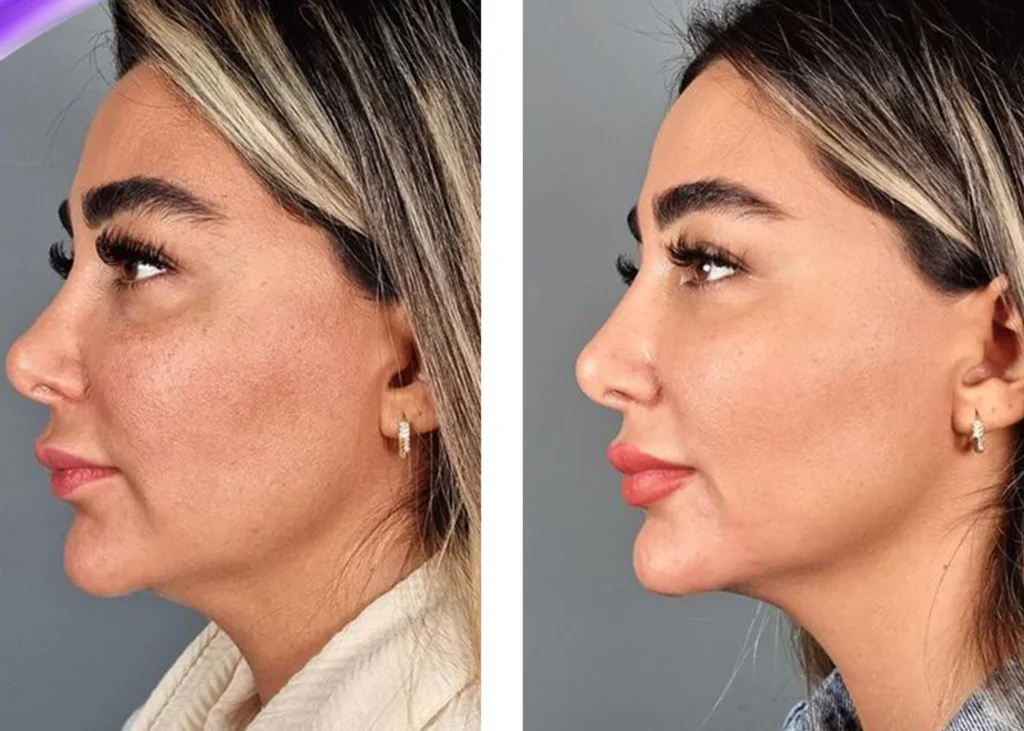 Clinic-supplied before and after thread-lift treatment result