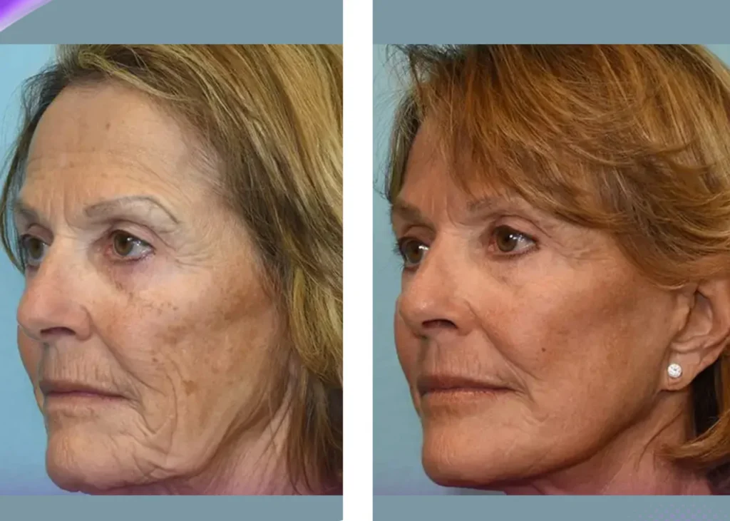 Clinic-supplied before and after thread-lift treatment result