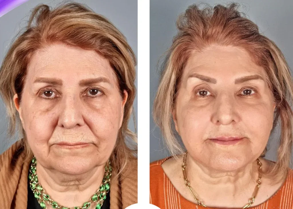 Clinic-supplied before and after thread-lift treatment result