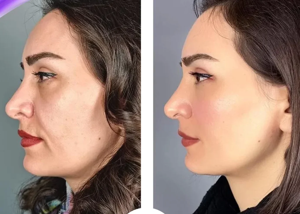 Clinic-supplied before and after thread-lift treatment result