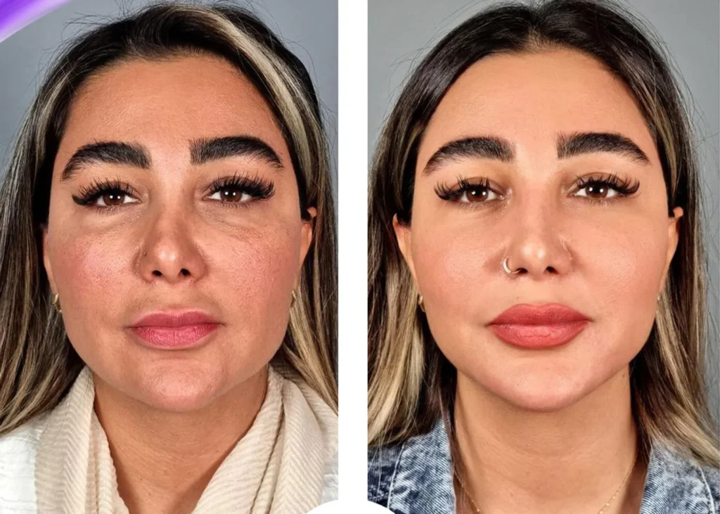 Clinic-supplied before and after thread-lift treatment result