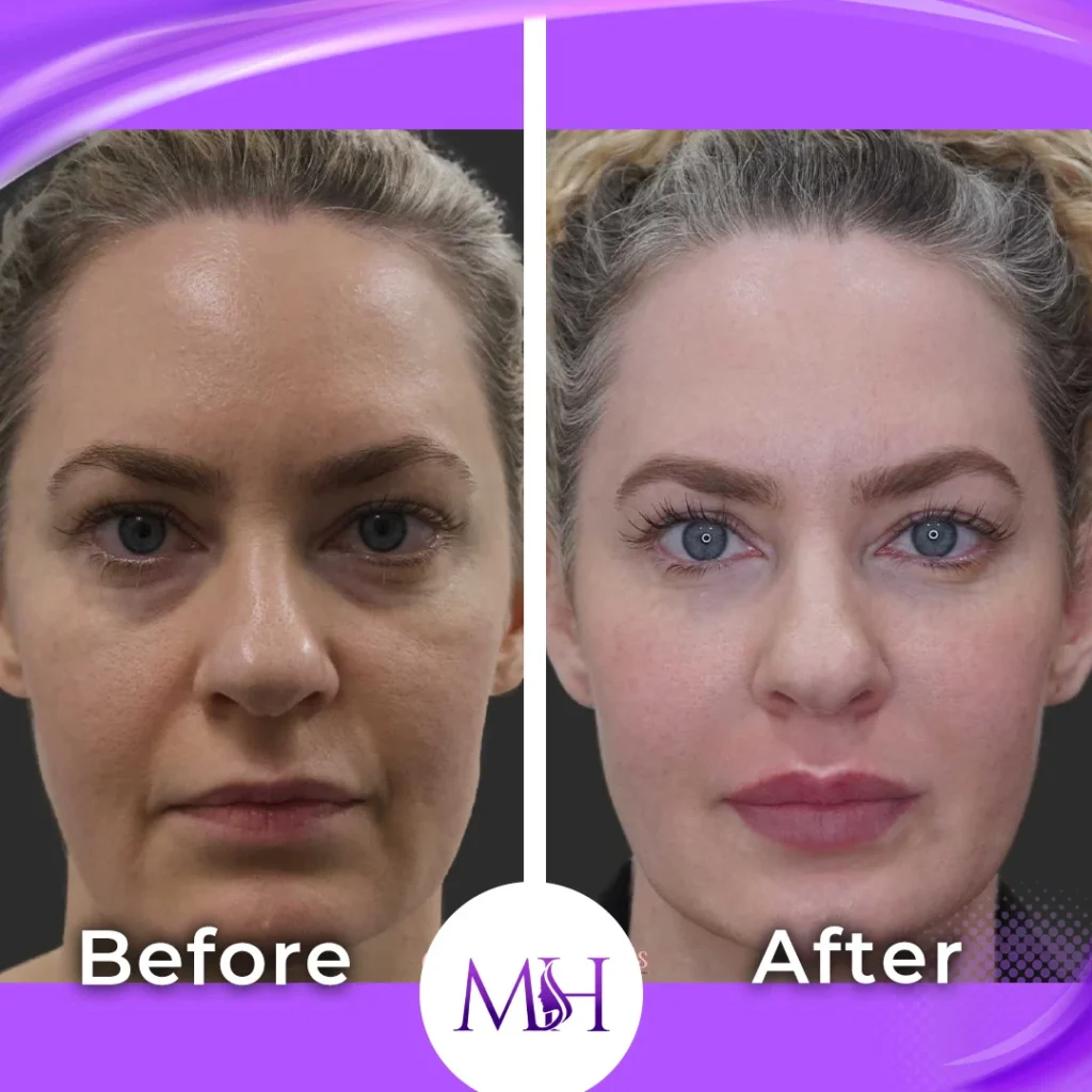 Clinic-supplied before and after under eye fillers case patient result