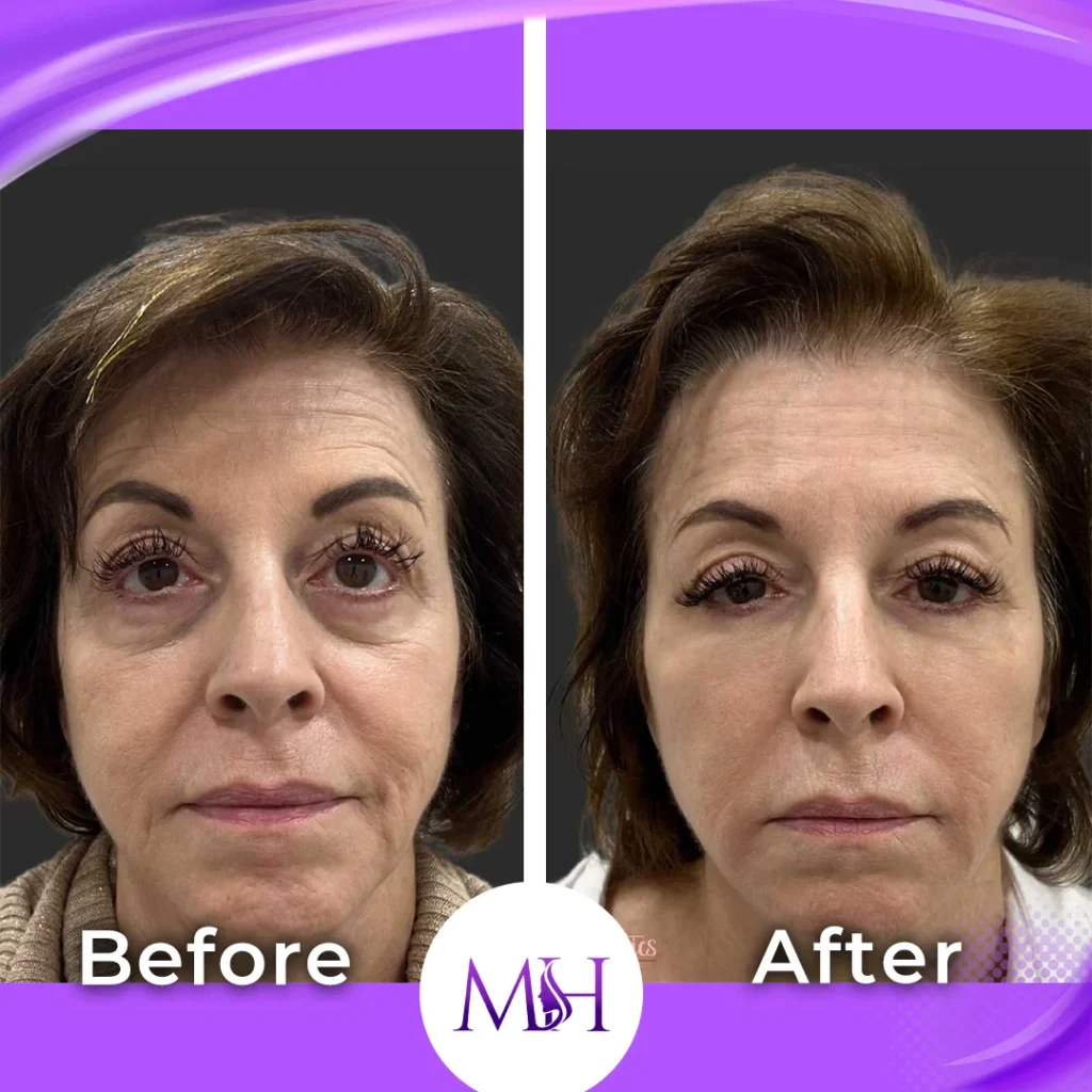 Clinic-supplied before and after under eye fillers case patient result