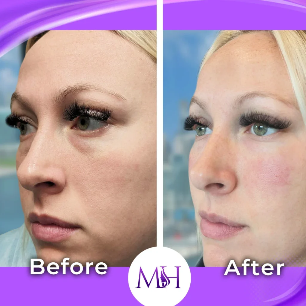 Clinic-supplied before and after under eye fillers case patient result