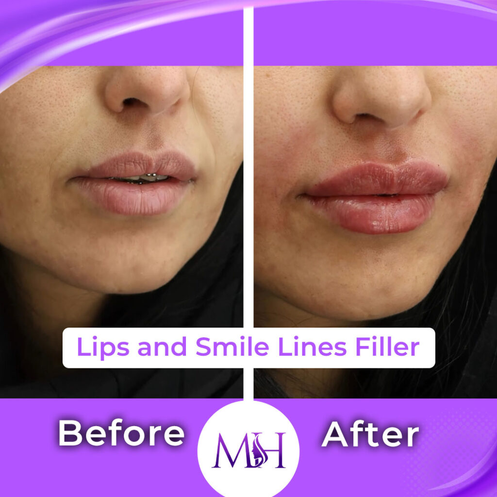 Lips and Smile Lines Filler (as labelled on supplied artwork); combined treatment, not an isolated smile-line result. Left Before; right After.