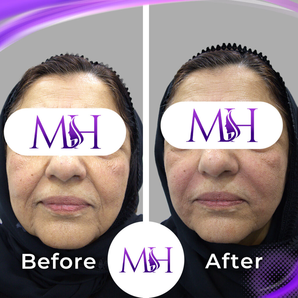 Smile-line filler; treatment context identified by the clinic. Left Before; right After.