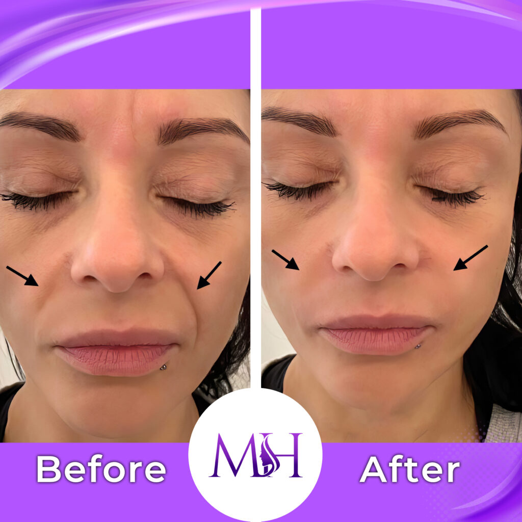 Smile-line filler; treatment context identified by the clinic. Left Before; right After.