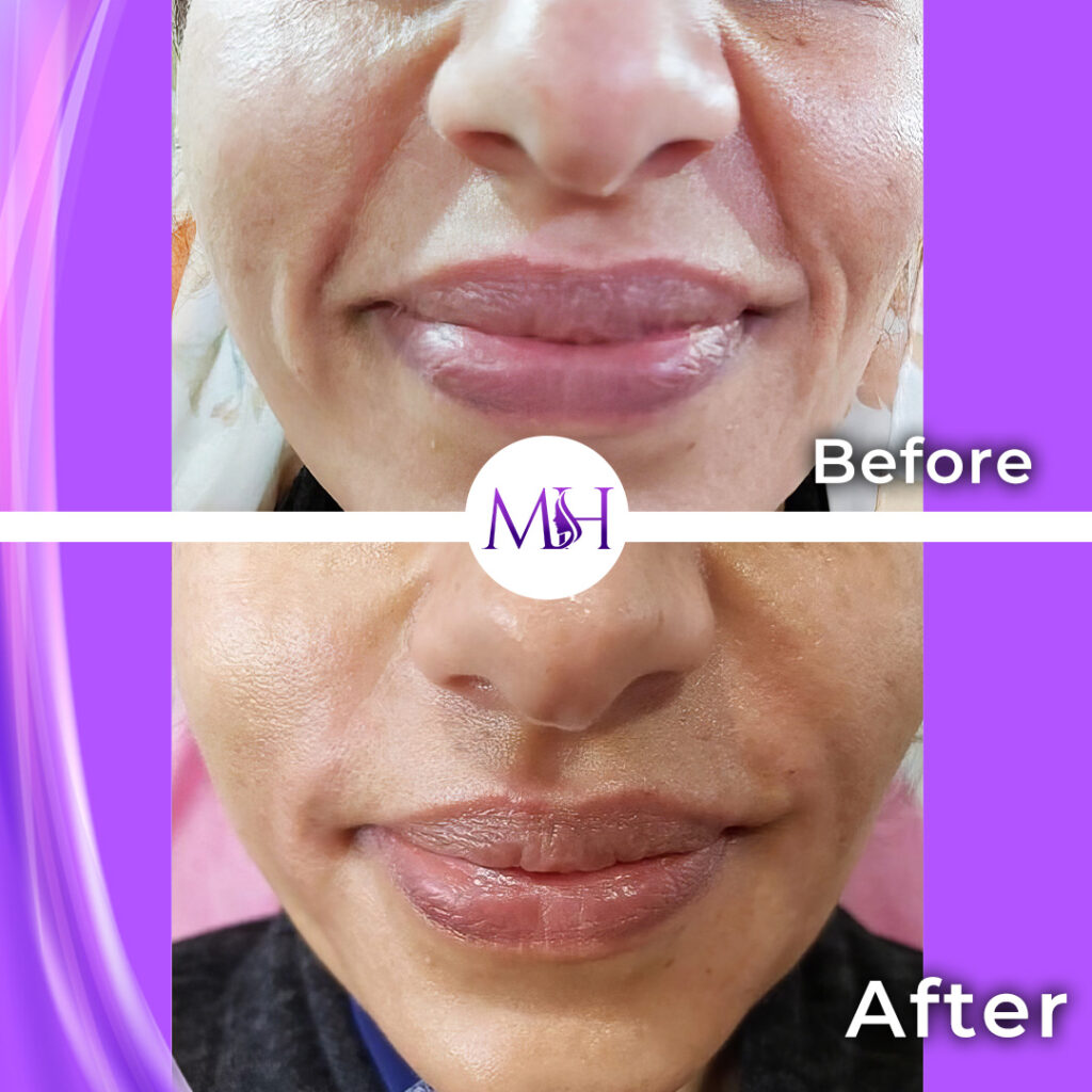 Smile-line filler; treatment context identified by the clinic. Top Before; bottom After.